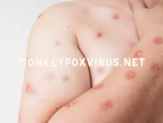 monkeypox mpox symptoms