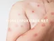 monkeypox mpox symptoms